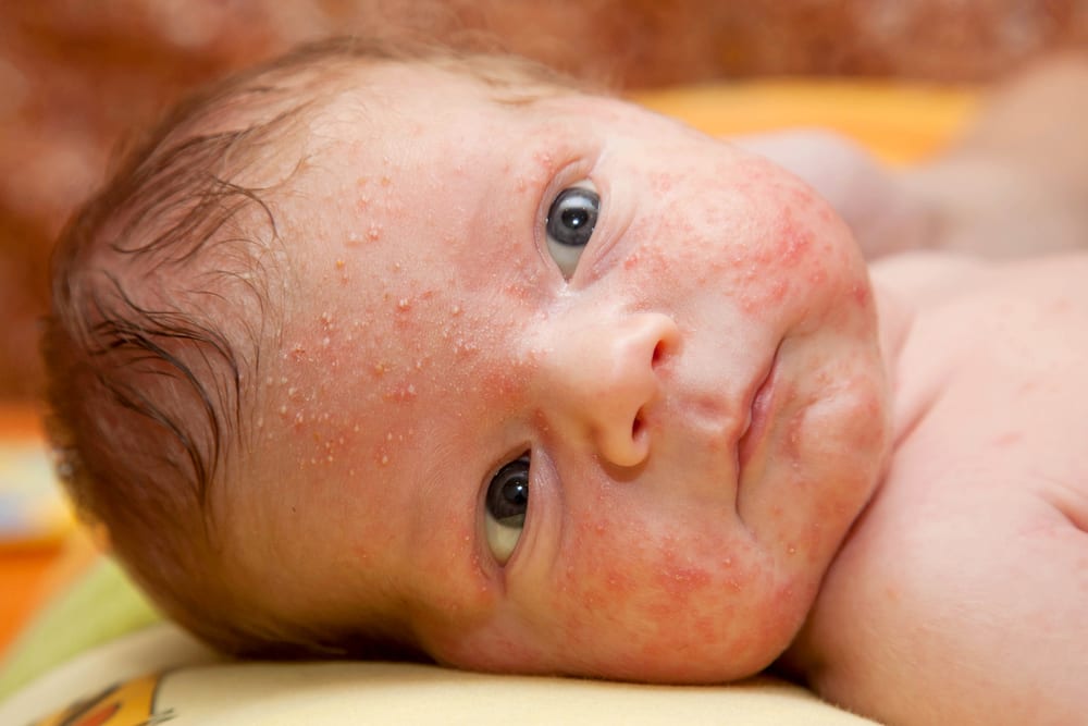 baby acne eczema skincare 