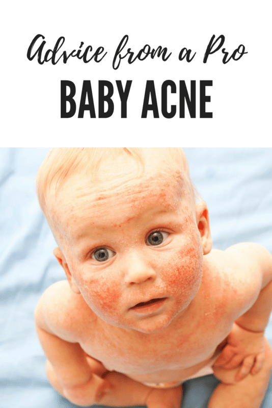baby acne FAQ skincare