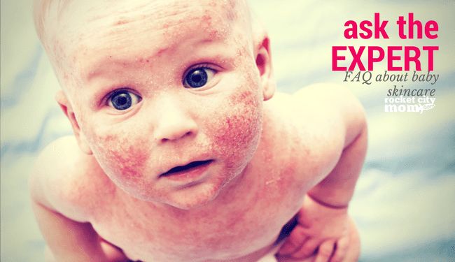 baby acne skin care